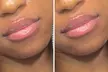 Get 1ML or 2ML Hyaluronic Acid Needle-less Lip Enhancements or Injection at Boho beauty and spa (Up to 30% Off) - Second Medium