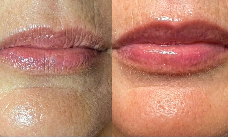 Image 2: Limpieza facial profunda con "BB lips" hidratación labial con dermapen