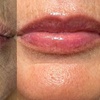 Image 2: Limpieza facial profunda con "BB lips" hidratación labial con dermapen