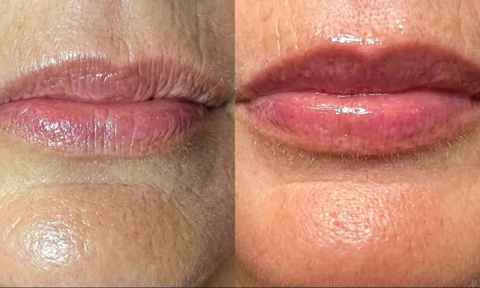 Limpieza facial profunda con "BB lips" hidratación labial con dermapen
