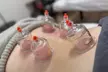 Experience the Benefits of Acupuncture w/ 1, 3 or 5 Sessions at Yoo Balance therapy and wellness (Up to 55% Off) - Second Medium