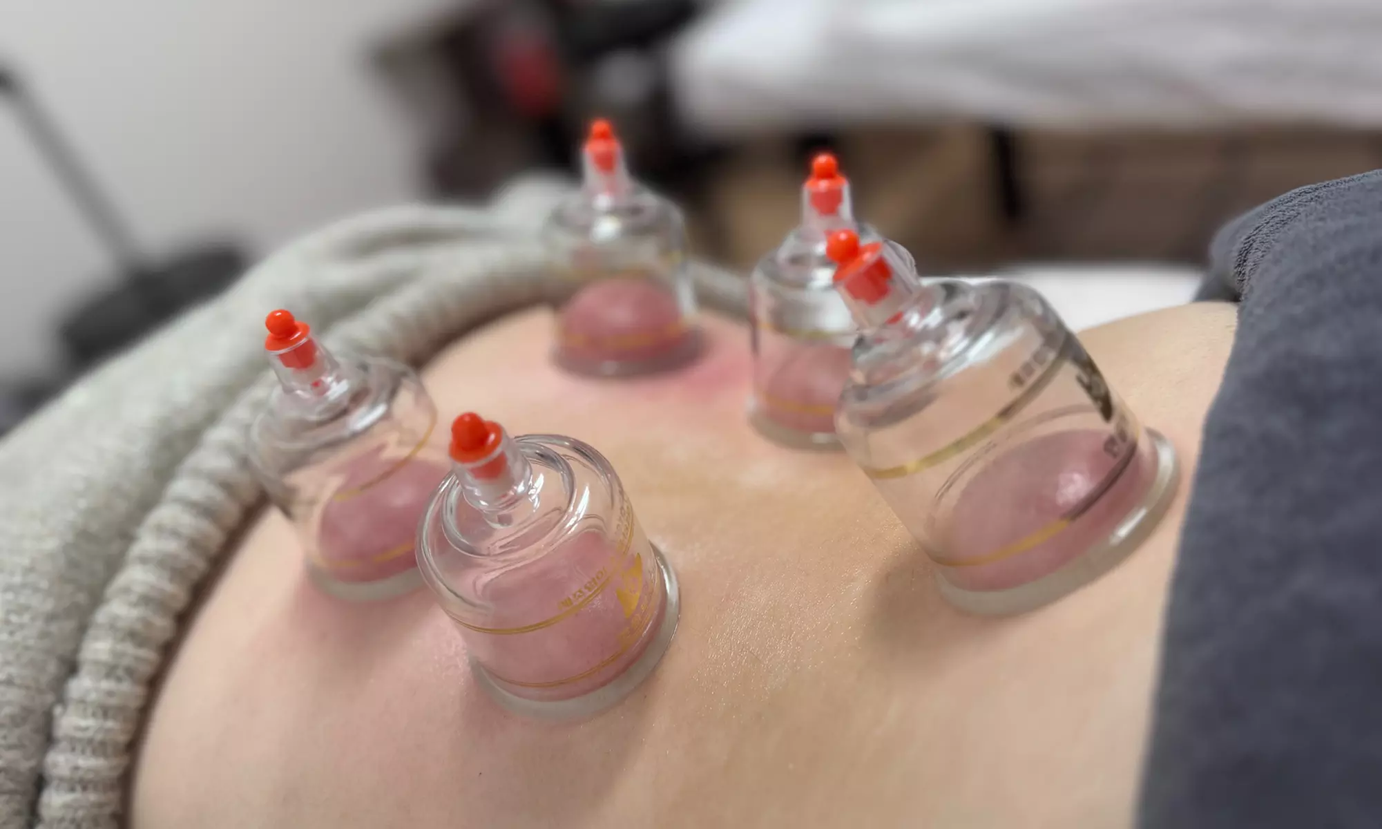 Experience the Benefits of Acupuncture with 1, 3, or 5 Sessions