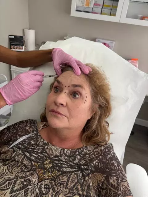 Refresh Your Look with 20 Units of Xeomin Injection