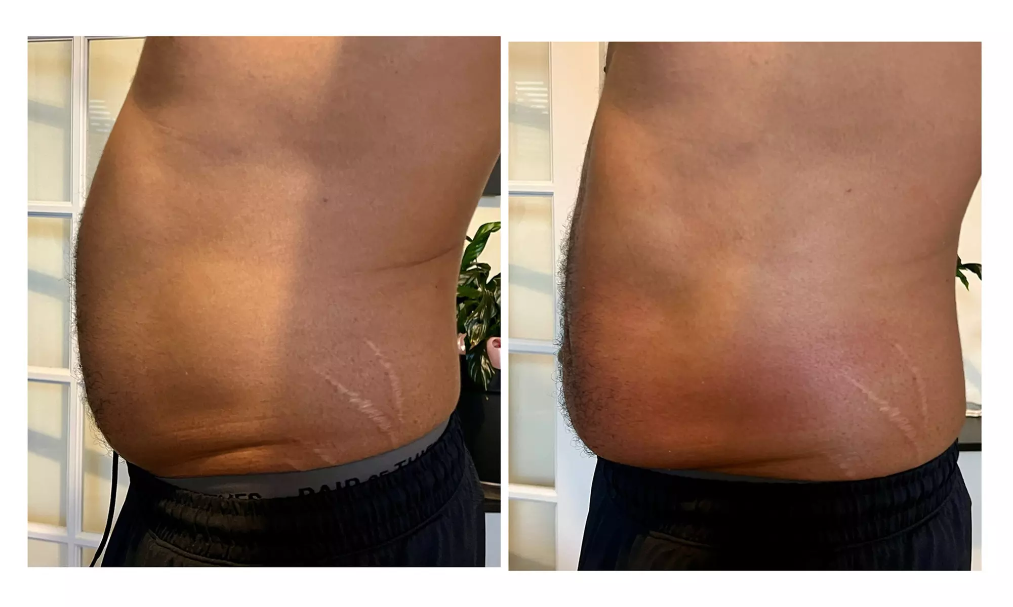 One, Three, or Six 60-Min Lipo-Cavitation and Radiofrequency Session