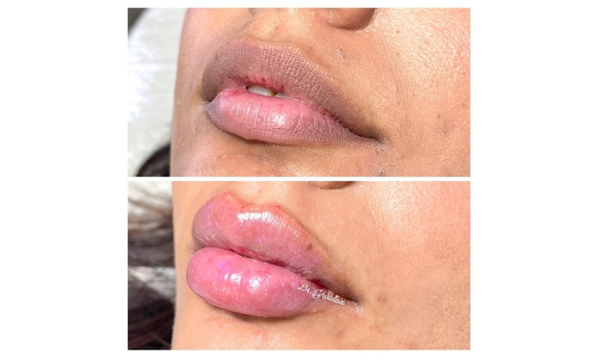 Image 10: Smooth, Plump & Perfect: Versa Enhancements at Divaa Beauty