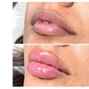 Image 10: Smooth, Plump & Perfect: Versa Enhancements at Divaa Beauty