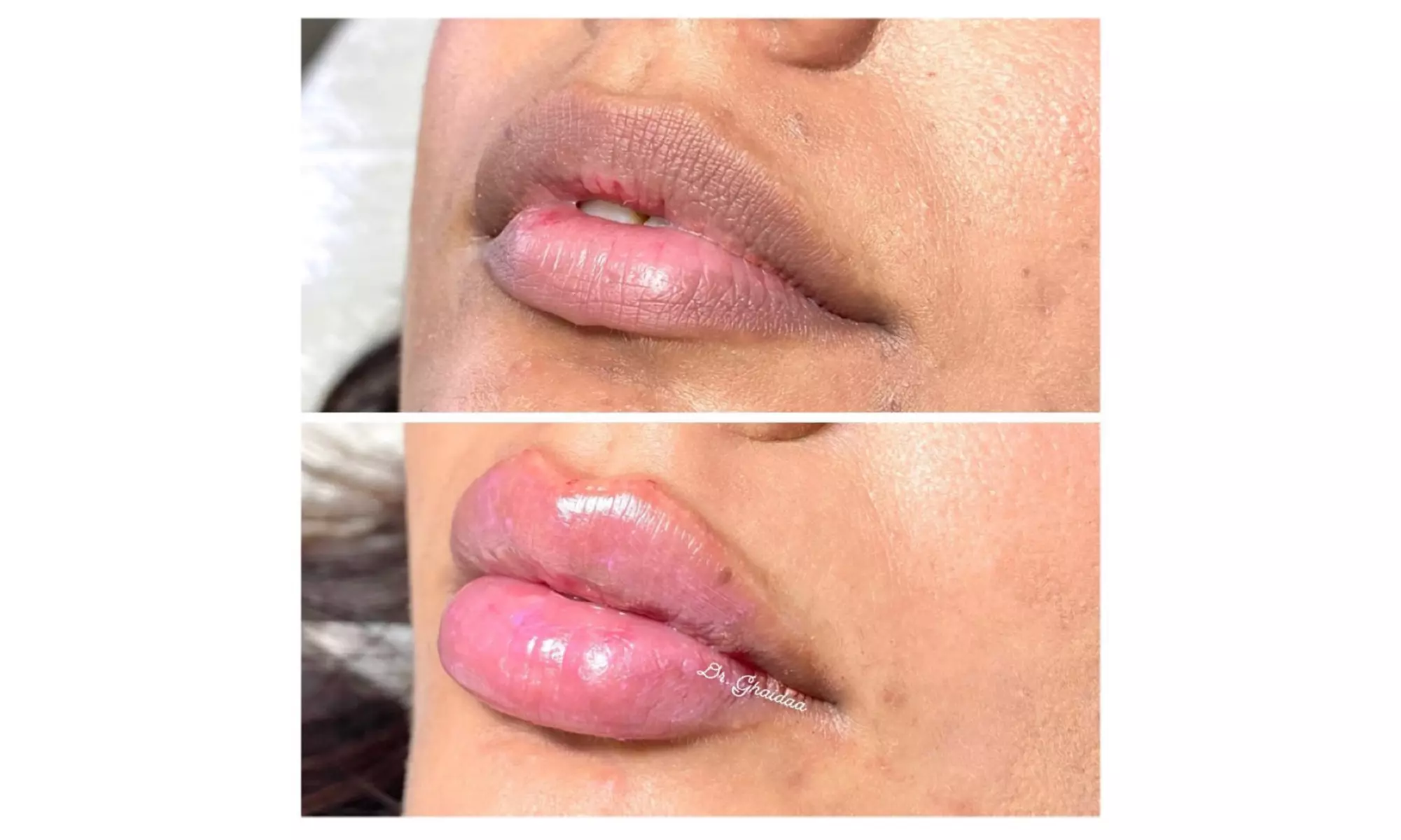 Smooth, Plump & Perfect: Versa Enhancements at Divaa Beauty
