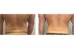 Up to 68% Off on Fat Reduction - Non-Branded at CryoSculpt Body Lab - Second Medium