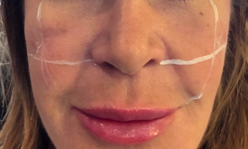 Image 6: Natural-Looking Rejuvenation with Evolysse & Lip Fillers