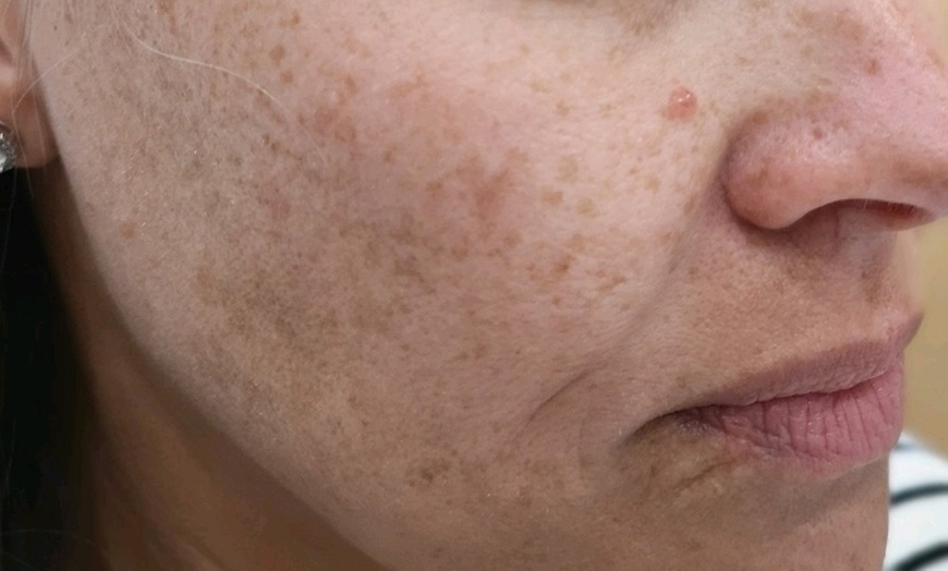 Image 4: Revitalize Your Skin with IPL Photofacial Treatments