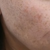 Image 4: Revitalize Your Skin with IPL Photofacial Treatments