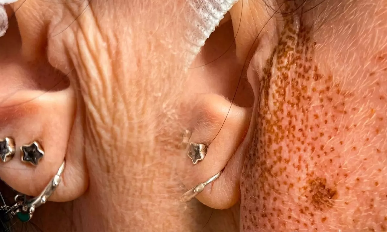 1 o 2 sesiones de plasma pen en zona a elegir para 1 persona