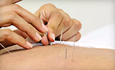 One or Two Acupuncture Sessions at Acupuncture Natural Wellness in Staten Island (Up to 82% Off) - Primary Image