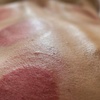 Image 3: Feel Better with One or Three Cupping Therapy Sessions