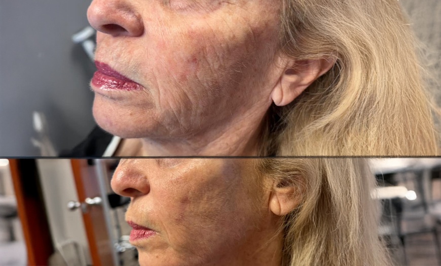 Image 1: 20, 40, 60 Units of Letybo or 1 Syringe of Juvederm Ultra XC (1.0mL)