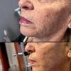 Image 1: Up to 44% Off on Injection-Other-Dysport, Xeomin at Health Now Family Practice Pluse Walk In Clinic