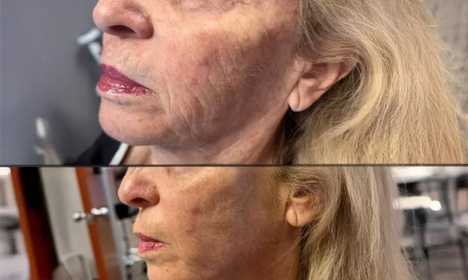 Transform Your Look with 20, 40, 60 Units of Letybo or 1 Syringe of Juvederm Ultra XC (1.0mL) (Up to 38% Off) - Primary Image