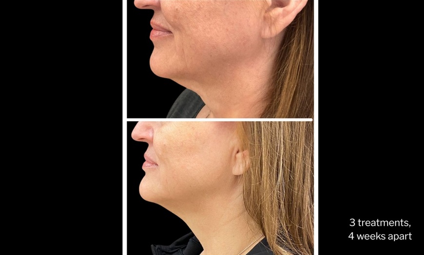 Image 9: Morpheus8 Non-surgical Tightening - Allure Passions Aesthetic Clinic