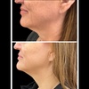 Image 9: Morpheus8 Non-surgical Tightening - Allure Passions Aesthetic Clinic