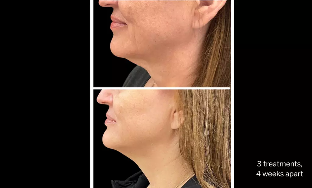 Morpheus8 Non-surgical Tightening - Allure Passions Aesthetic Clinic