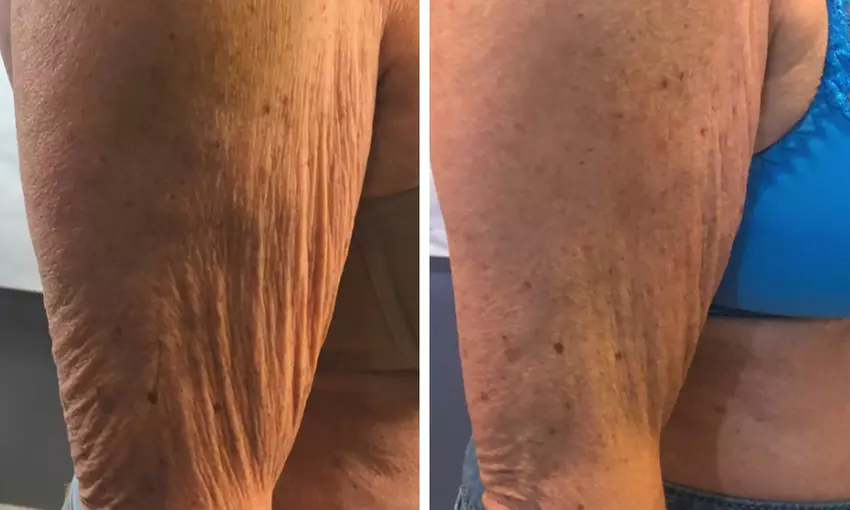 Transform with One Cryoslimming Treatment and Optional EMS Treatments 