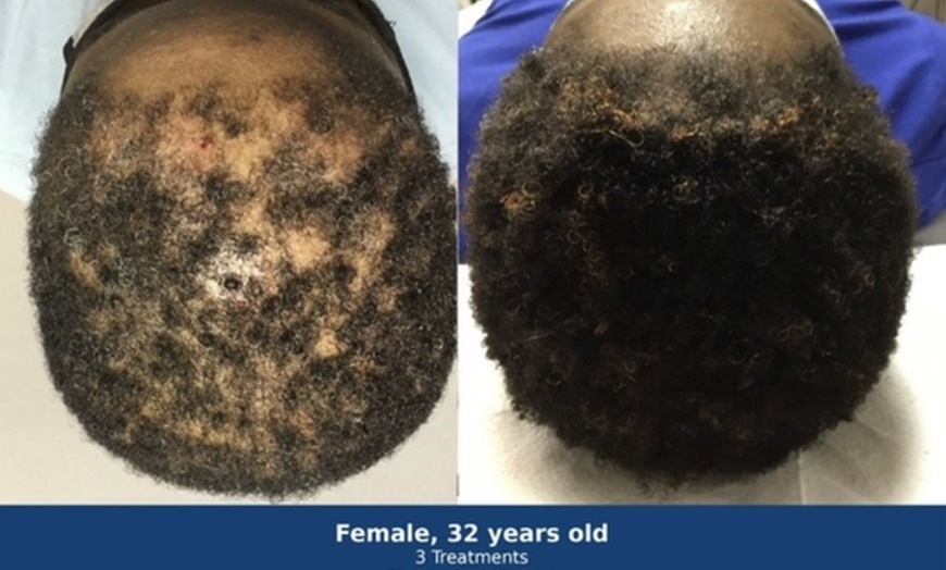Image 3: Hair Loss Treatments for Two Areas with Ultrasound and Peptides