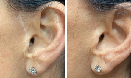 1 Scar Camouflage or Stretch Mark Revision (Small Area)  2 hrs. - The Camo Clinic