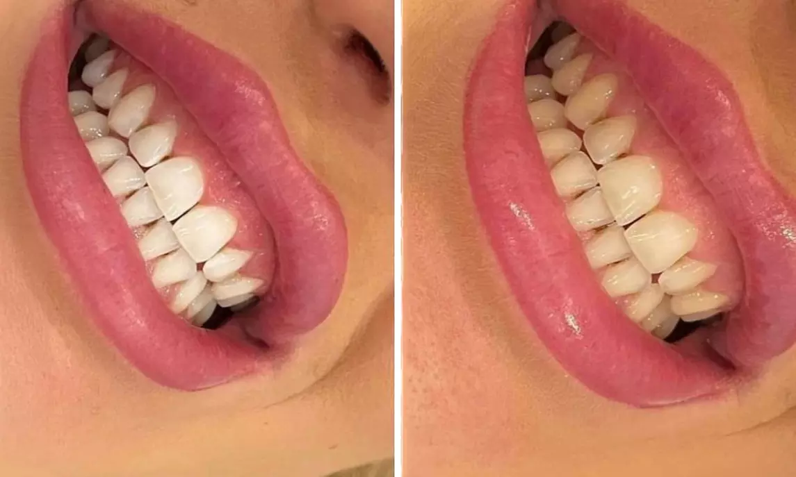 1, 2 oder 3 kosmetische Zahn-Bleachings für 1 Person