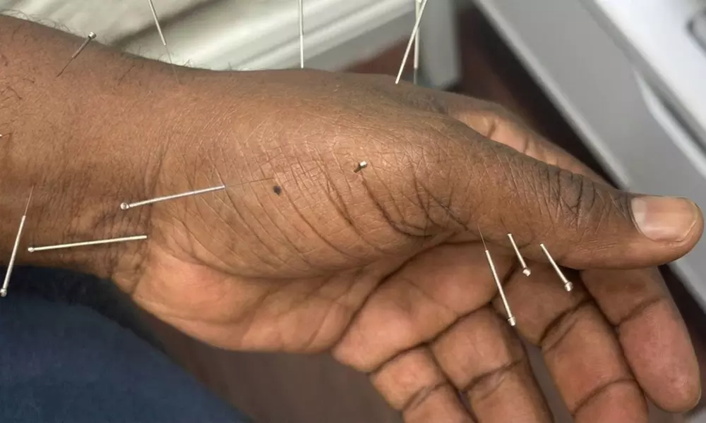 One, Three, or Five Acupuncture Sessions for Chronic Pain Relief