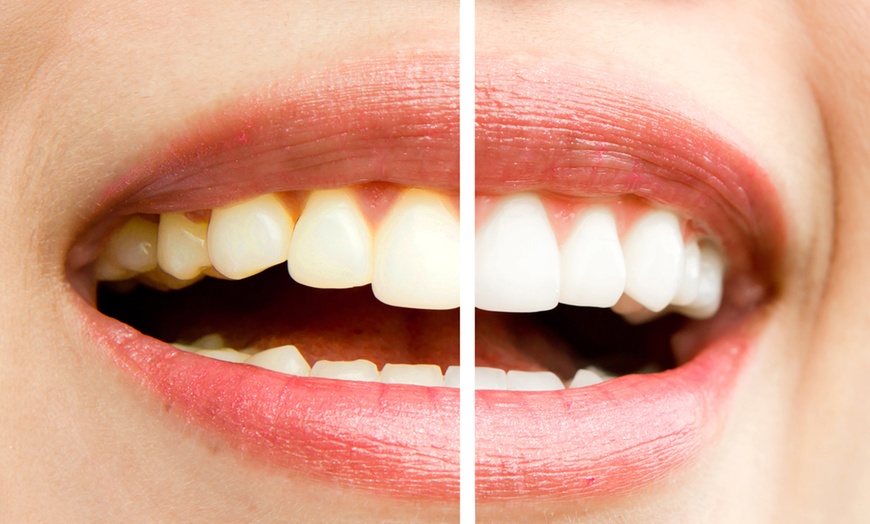 Image 5: 30 or 60-Minute Teeth Whitening Or 60-Minute Teeth Whitening for Two