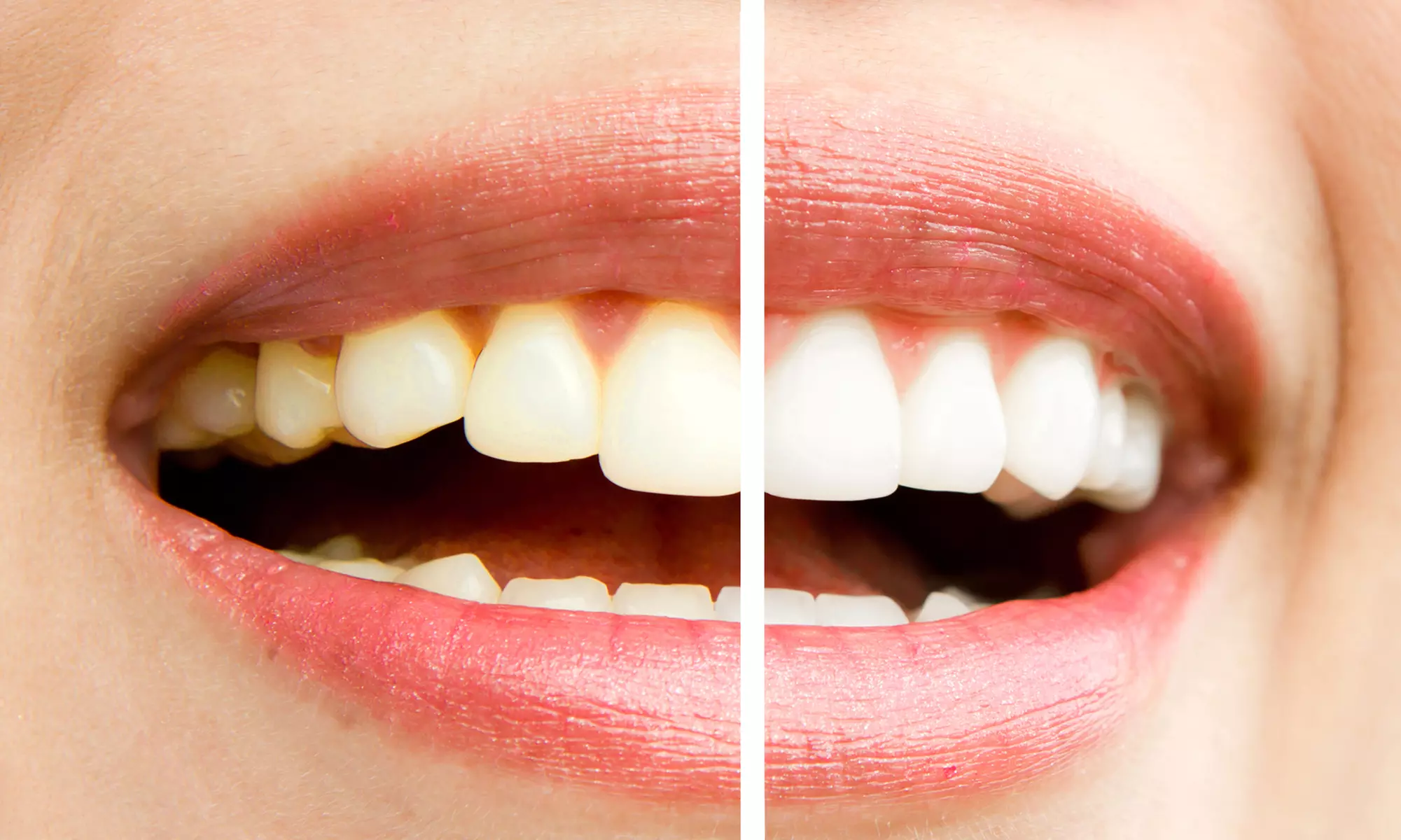 30 or 60-Minute Teeth Whitening Or 60-Minute Teeth Whitening for Two