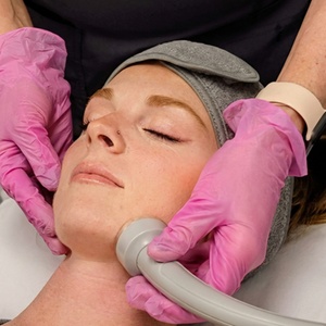 Two Ultra Lift Face Lift Sessions - Elevé Rejuvenation Labs