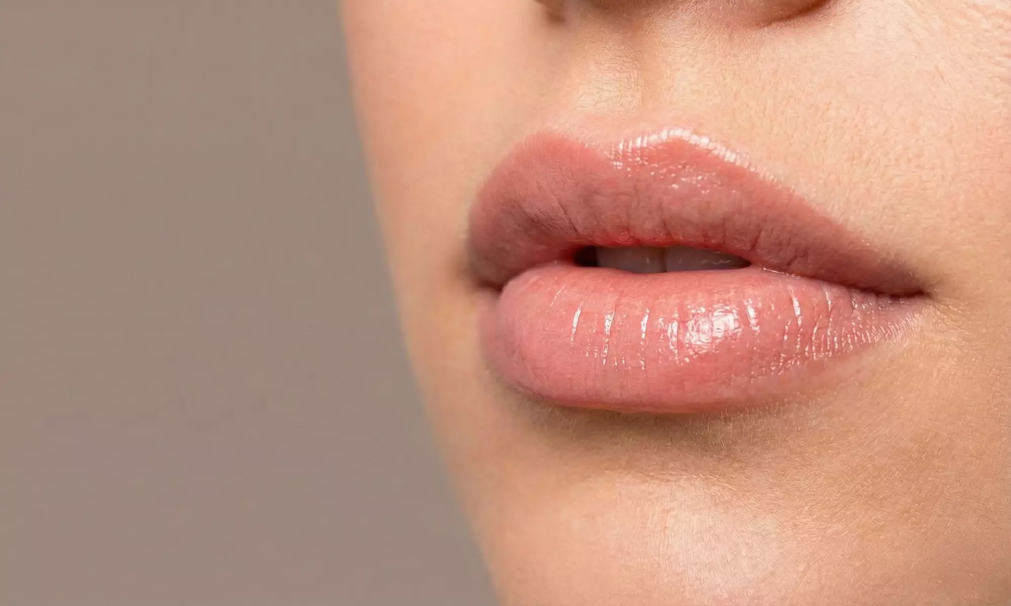 Infiltración de 1 vial de relleno dérmico en labios para 1 persona