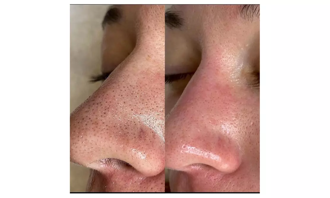 Rejuvenate w/ Hydrafacial with Peel-Off Mask, LED Therapy, & Dermaplaning or Double the Treatment (Up to 53%Off) - Second Medium