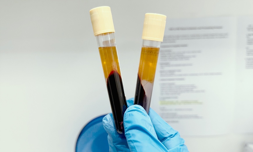 Image 3: Revitalize w/ 1,2,or 3 Sessions of PRP Full Face Includes Under eyes 