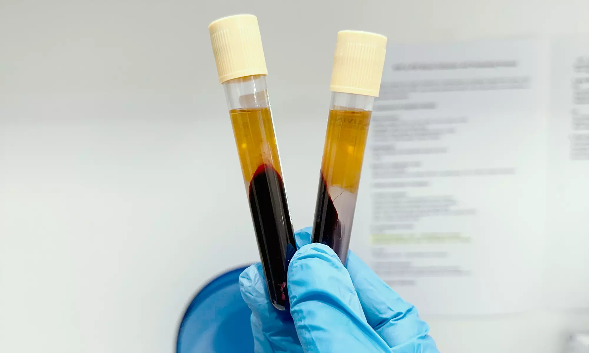 Revitalize w/ 1,2,or 3 Sessions of PRP Full Face Includes Under eyes