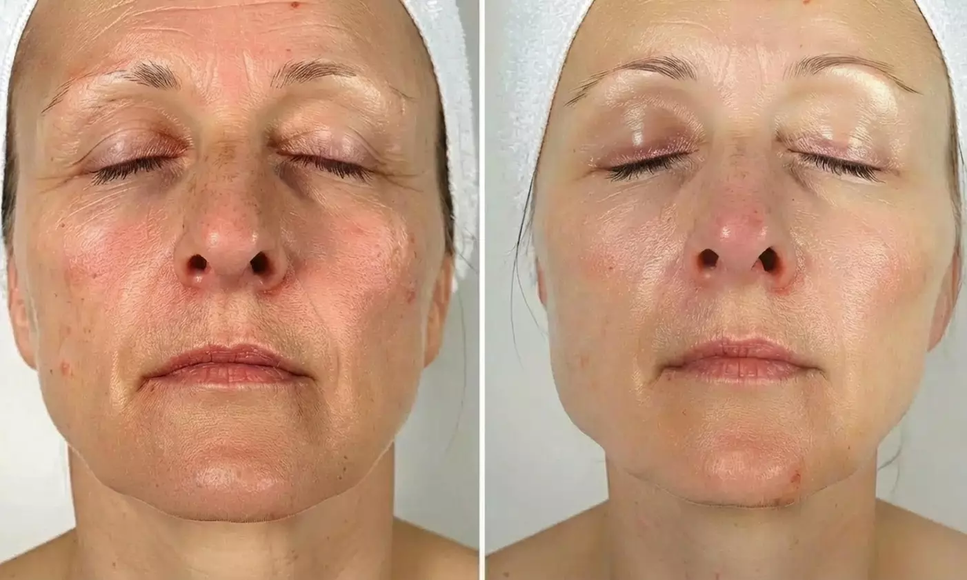 One or Two Sessions of Polynucleotide Skin Treatment for Eyes or Face