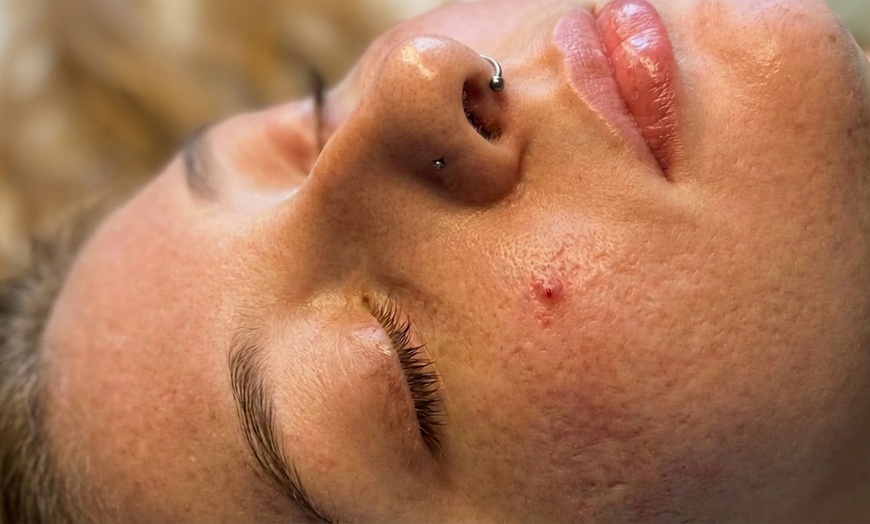 Image 2: One, Two, Three or Four Professional Grade Pro Chemical Peels