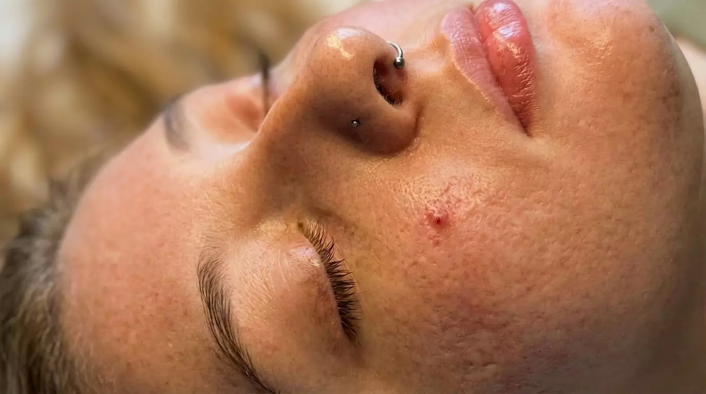 One, Two, Three or Four Professional Grade Pro Chemical Peels