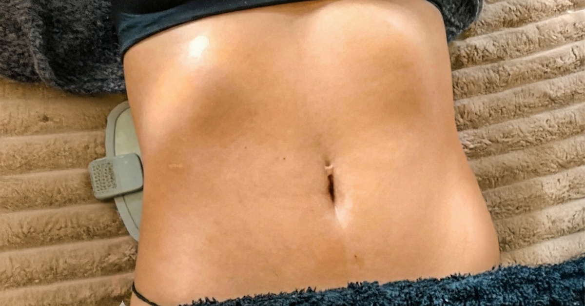 Sesiones de radiofrecuencia, presoterapia y termoterapia en Madrid