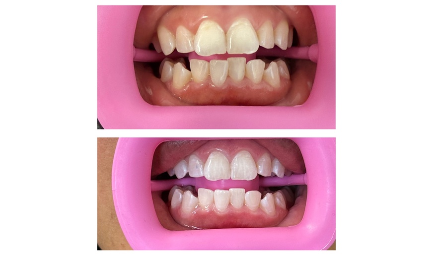 Image 3: Brighten Your Smile with 30 or 60 Minute Teeth Whitening Session 