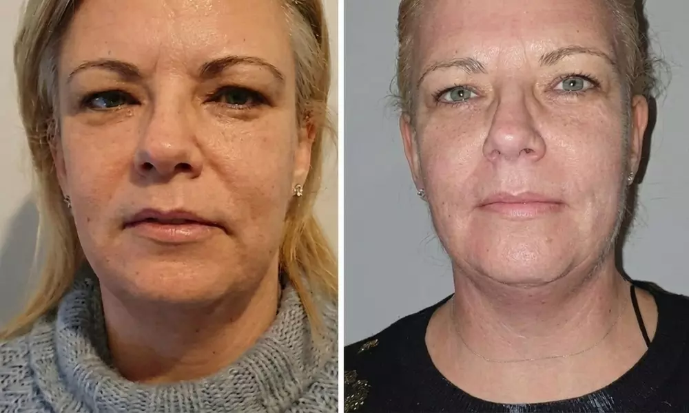 8D Hifu Face and Neck Lift with Two Complimentary Mini RF Treatments