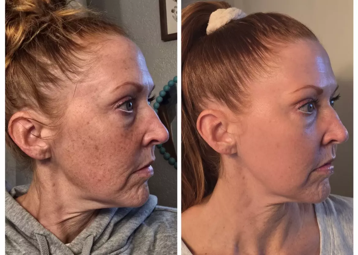 One or Two Laser Skin Resurfacing Treatments