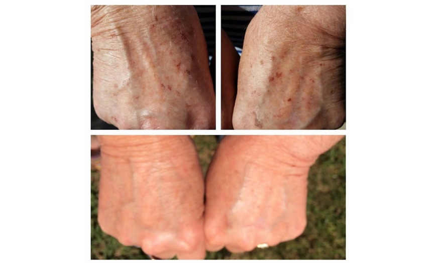 Image 6: 1, 2, or 3 IPL Photo Facials to Target Redness, Pigmentation & Texture