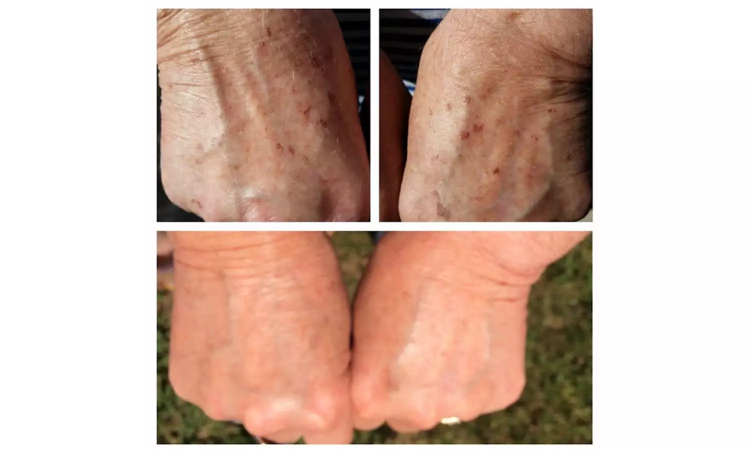 1, 2, or 3 IPL Photo Facials to Target Redness, Pigmentation & Texture