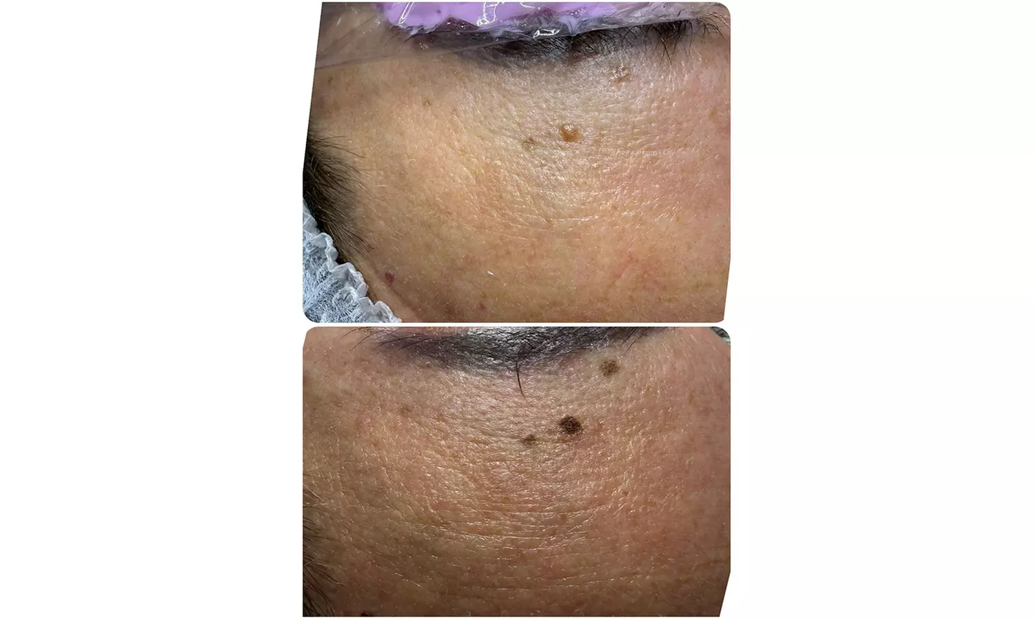 Plasma pen facial no quirúrgico para manchas y zona periocular