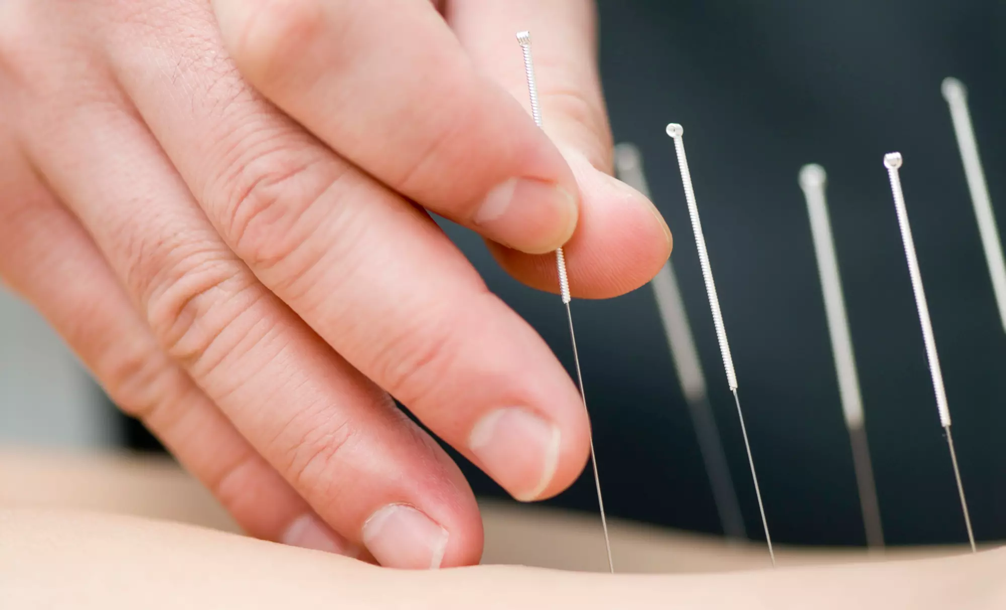 Up to 50% Off on Acupuncture at Maple Acupuncture - Primary Image