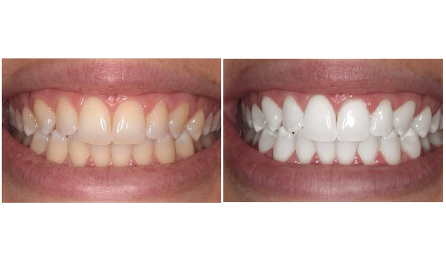 Image 2: Offrez à votre sourire un éclat naturel avec le blanchiment dentaire