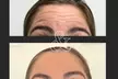 Get 20, 40 or 60 Units of Xeomin or Jeuveau at Great Falls Aesthetics (Up to 33% off) - Second Medium