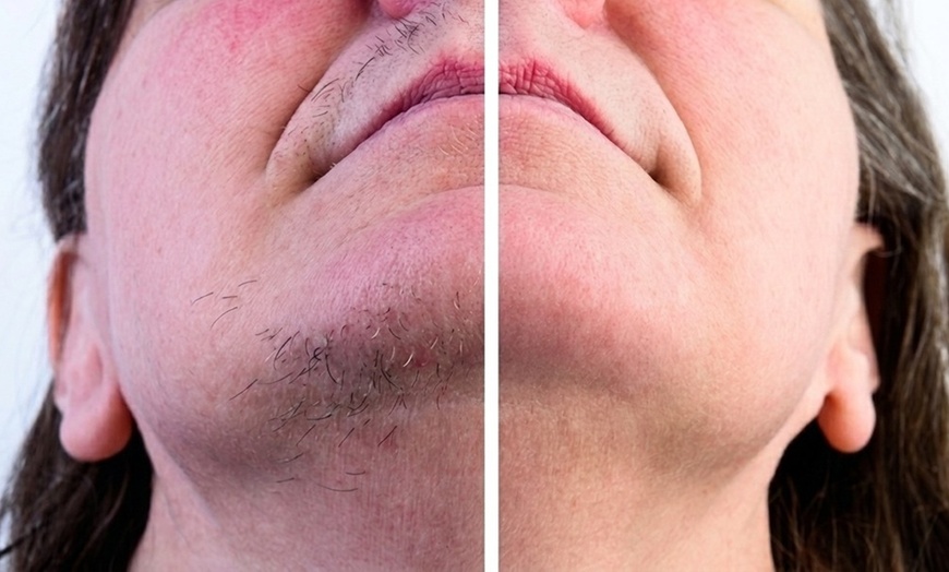 Image 4: 30 or 60-Minute Electrolysis Sessions for Long-Lasting Hair Reduction